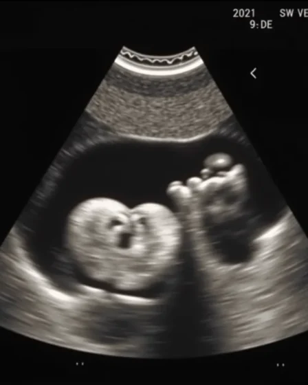 Zespół Downa na USG: Jakie są możliwości diagnozy?